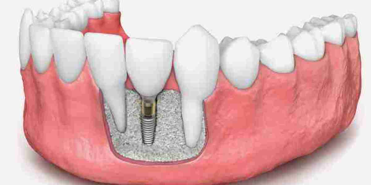 The Role of Alloplast in the Dental Bone Graft Substitute Market