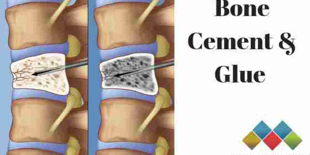 Top Companies in the Bone Cement and Glue Market