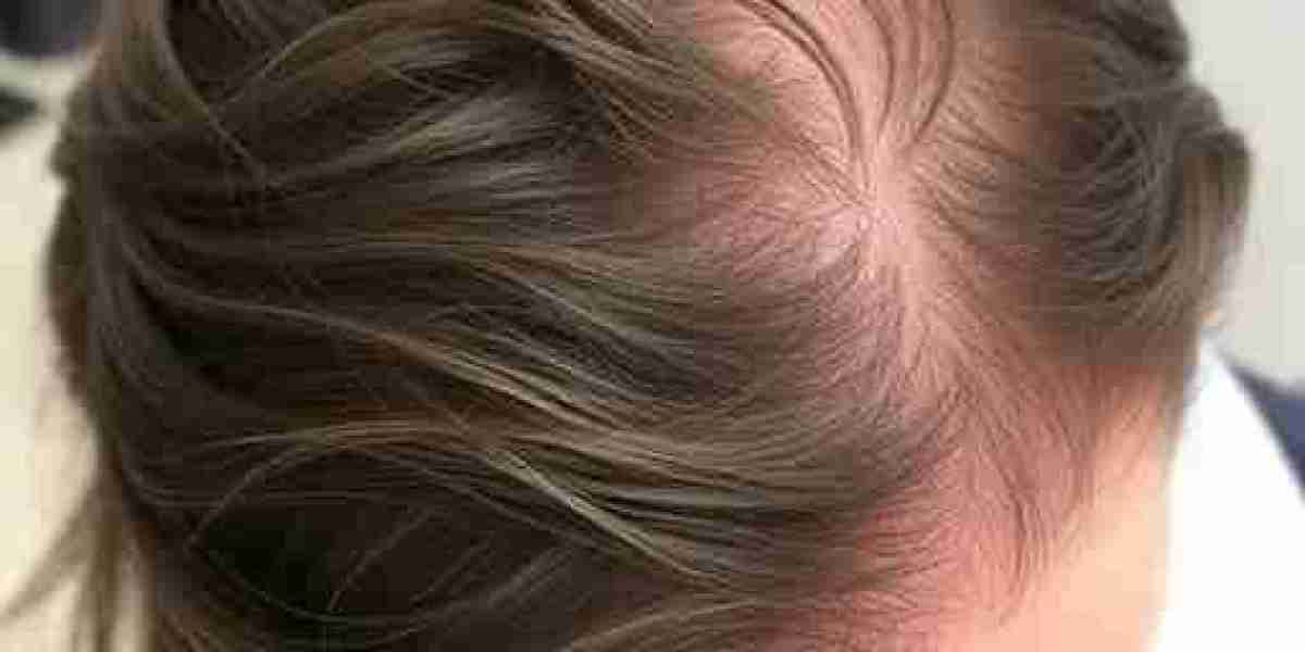 Success Stories: Real Results of PRP Treatment for Hair Loss