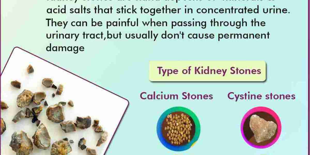 Types of Urinary Stones and How They Impact Your Health